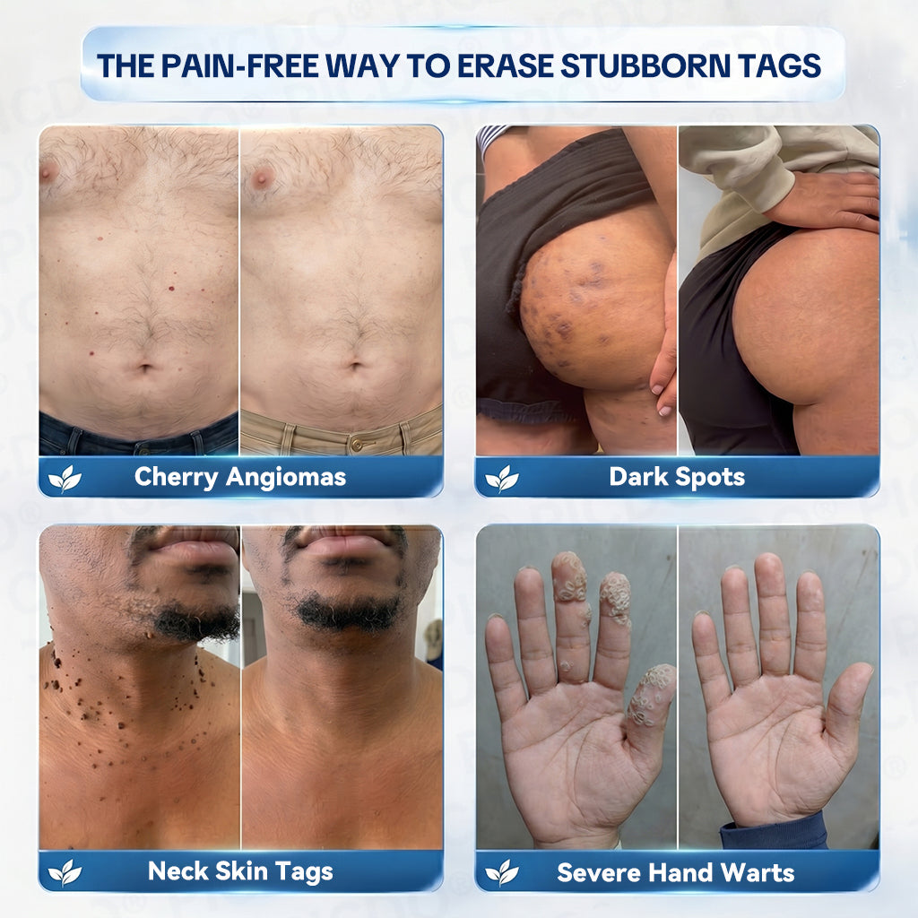 𝐏𝐢𝐜𝐝𝐨® 7-𝐃𝐚𝐲 𝐒𝐤𝐢𝐧 𝐓𝐚𝐠 & 𝐒𝐩𝐨𝐭 𝐄𝐫𝐚𝐬𝐞𝐫 𝐂𝐫𝐞𝐚𝐦 (Zero Pain, Zero 𝐒𝐜𝐚𝐫𝐬 Formula) 🍁