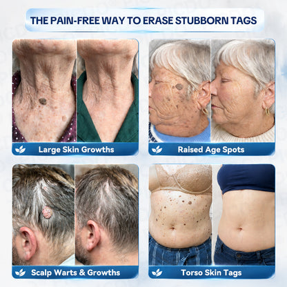 𝐏𝐢𝐜𝐝𝐨® 7-𝐃𝐚𝐲 𝐒𝐤𝐢𝐧 𝐓𝐚𝐠 & 𝐒𝐩𝐨𝐭 𝐄𝐫𝐚𝐬𝐞𝐫 𝐂𝐫𝐞𝐚𝐦 (Zero Pain, Zero 𝐒𝐜𝐚𝐫𝐬 Formula) 🍁