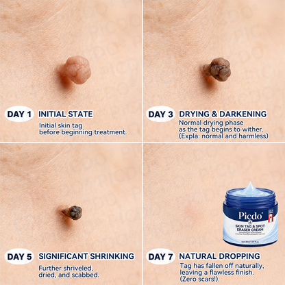𝐏𝐢𝐜𝐝𝐨® 7-𝐃𝐚𝐲 𝐒𝐤𝐢𝐧 𝐓𝐚𝐠 & 𝐒𝐩𝐨𝐭 𝐄𝐫𝐚𝐬𝐞𝐫 𝐂𝐫𝐞𝐚𝐦 (Zero Pain, Zero 𝐒𝐜𝐚𝐫𝐬 Formula) 🍁
