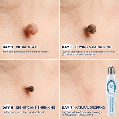 𝐏i𝐜𝐝o® 7-𝐷𝑎𝑦 𝗧𝐚𝐠 & 𝗦𝗽𝐨𝐭 𝐄𝐫𝒂𝒔𝒆𝒓✅🚀(Zero Pain, Zero 𝐒𝐜𝐚𝒓𝒔 Rollerball)